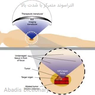 التراسوند متمرکز با شدت بالا
